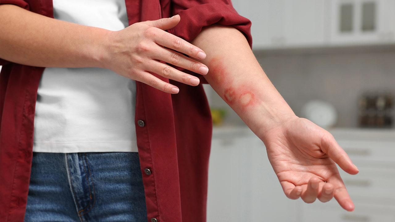 טיפול בכוויות בבית